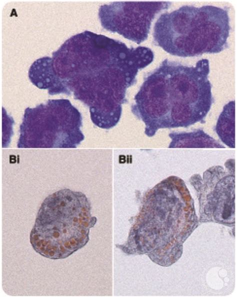 Orange-colored Russell bodies by Papanicolaou stain