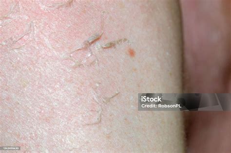 Irritated Reddened Skin With Flaking Cell Scales After Sunburn Stock