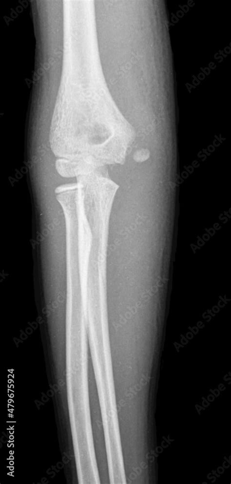 Foto De X Ray Image Of Medial Epicondyle Fracture An Avulsion Injury