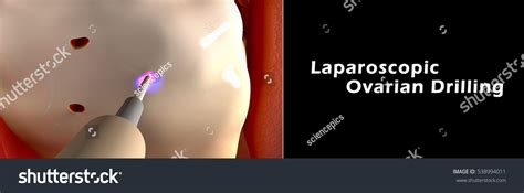 Laparoscopic Ovarian Drilling 3d Illustration Stock Illustration