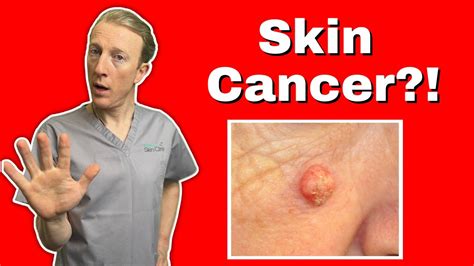 Squamous Cell Skin Cancer Scc What You Need To Know For Early