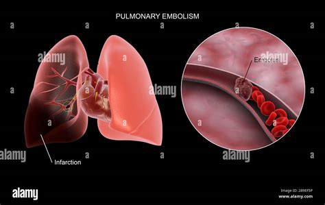 Embolia Pulmonar Masiva