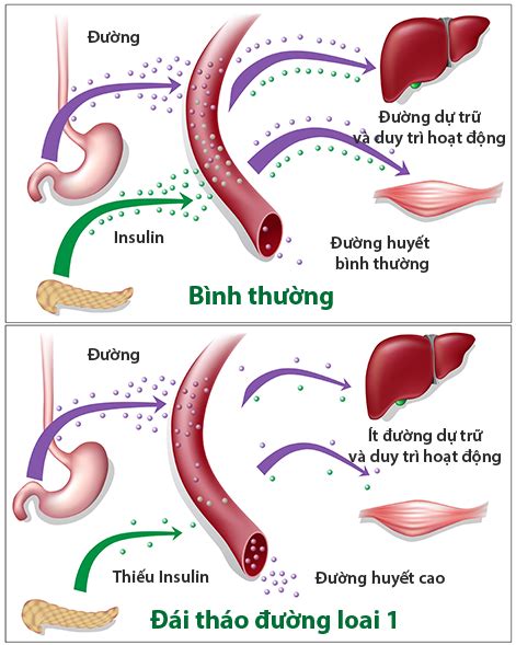 Bệnh Tiểu đường Type 1 Hay Còn Gọi Là đái Tháo đường