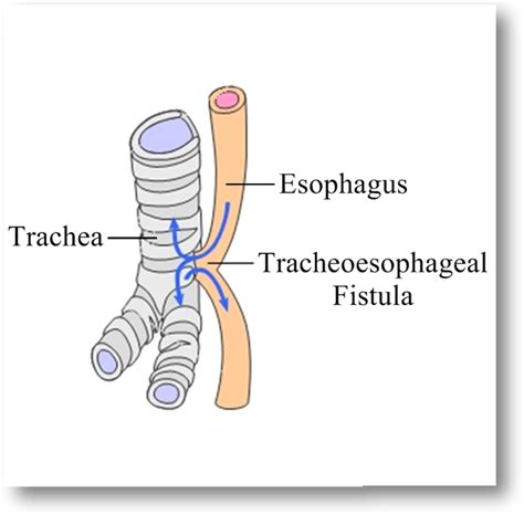 Symptoms Of Tracheoesophageal Fistula In Adults - servbertyl