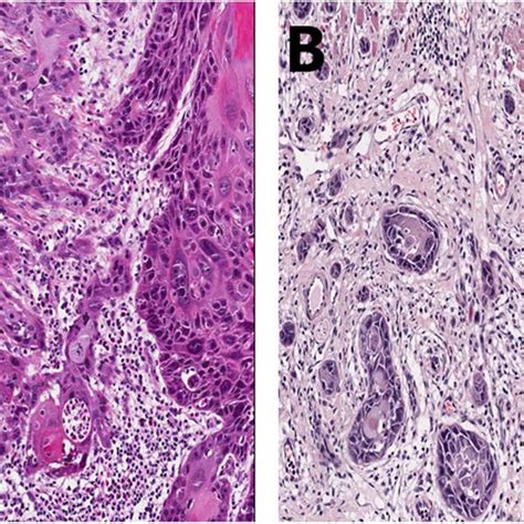 Hematoxylin And Eosin Stained Sections Of Oral Squamous Cell Carcinoma Download Scientific