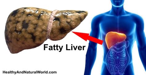 Fatty Liver - Signs, Symptoms and How to Prevent It