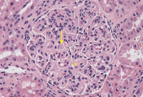 Systemic Lupus Erythematosus Kidney