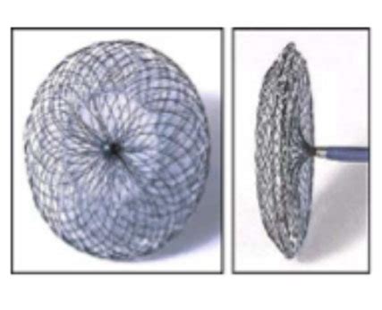 ASD Device Closure - Dr N Srinath Reddy - Pediatric Cardiologist