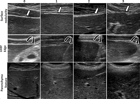 Accuracy Of Routine Clinical Ultrasound For Staging Of Liver Fibrosis