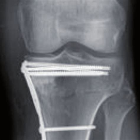 Ap Radiograph Of A Medial Tibial Plateau Fracture Treated By Orif With