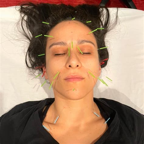 Facial Rejuvenation Acupuncture | Emerge Integrative Wellness