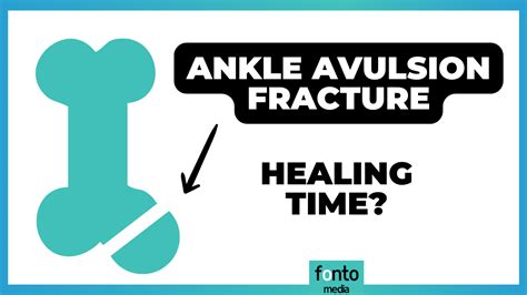 Understanding Avulsion Fracture Ankle Recovery And Healing Time