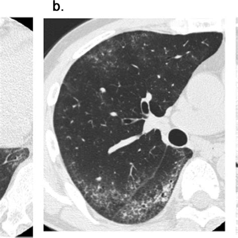 Ground Glass Attenuation A Thin Section Ct Scan Of The Right Lung In