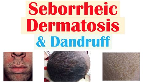 Seborrheic Dermatitis Scalp