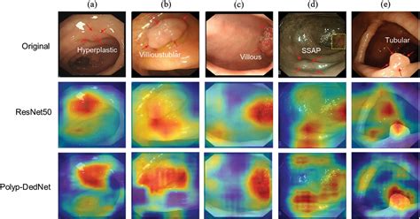 Cmc Free Full Text Multi Classification Of Polyps In Colonoscopy