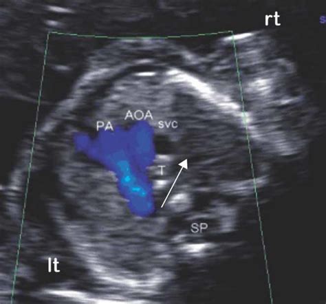 Subclavian Artery Ultrasound