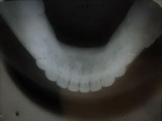 Radiología Dental Radiografía Oclusal