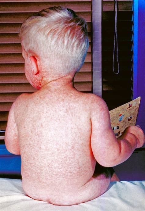 Vaccine Injury Claims Are Few and Far Between - The New York Times