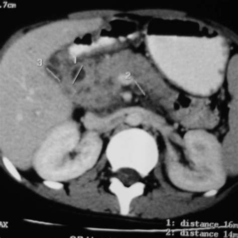 Cect Abdomen Showing Peripancreatic Lymph Nodes With Central Necrosis