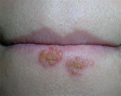 Cold Sore Stages (with Pictures) - The 5 Stages of Cold Sore Outbreak