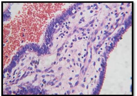 Chronic Salpingitis Lamina Propria Showing Lymphoplasmacytic