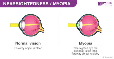 Myopia Causes, Symptoms, Formula And Nearsightedness