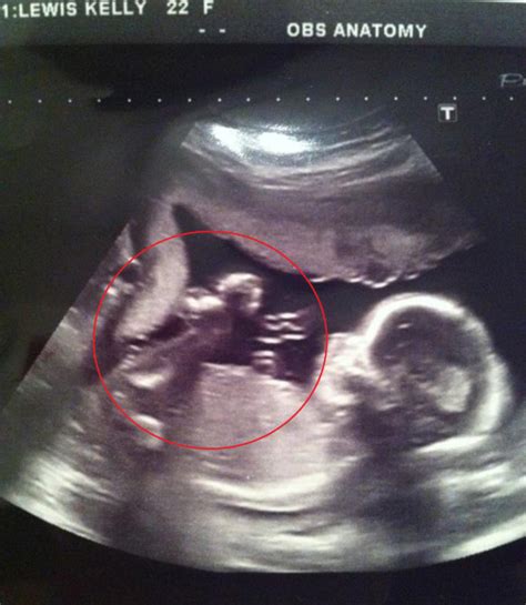 Mom shares ultrasound photo of an 'angel' watching over baby - TODAY.com