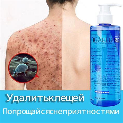 IUALLURE Гель для душа от прыщей, черных точек, акне и пигментных пятен ...