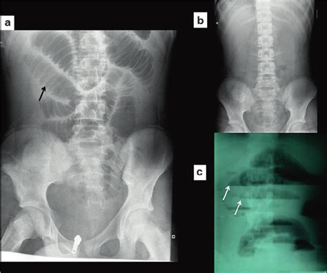 Small Bowel Obstruction A Multiple Loops Of Gas Filled Distended Download Scientific Diagram