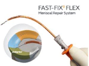 Smith Nephew Launches Fast Fix Flex Meniscal Repair System Indiamedtoday