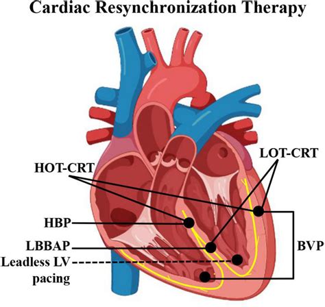 Schematic Diagram Of Pacing Electrode Positions Of Different Crt