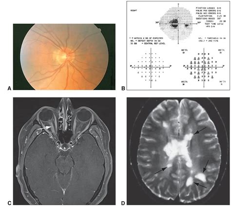 Retrobulbar optic neuritis - American Academy of Ophthalmology