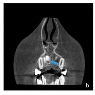 The Sagital A Axial B And Coronal C Slices Of Cbct Show An Impacted