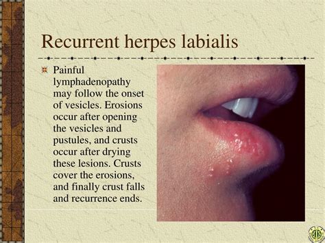 PPT - Herpes simplex PowerPoint Presentation, free download - ID:4856016