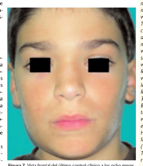 Figure 1 From Fibroma Osificante De Mandibula Presentacion De Un Caso Semantic Scholar