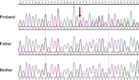 A Novel Frameshift Variant In Son Causes Zhutokitatakenouchikim