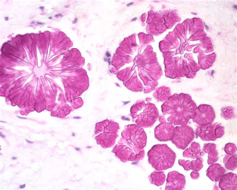 Tyrosine Crystals Pleomorphic Adenoma