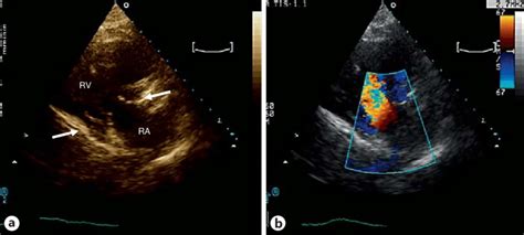 Transthoracic Echocardiogram Of The Tricuspid Valve In Chd Ra Right