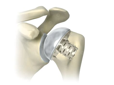 Illustration Arthrose Des Schultergelenks Medicalgraphics