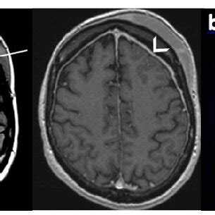 Image Findings In Patient A Mri Of The Brain With Contrast Showed