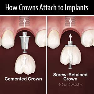 Screw or Cement: Which is Best for Attaching Your Implant Crown ...