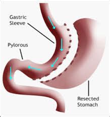 Delhi Obesity Clinic | Laparoscopic Sleeve Gastrectomy