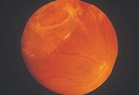 Panoramic Imaging Of The Ocular Fundus Cataract And Other Lens