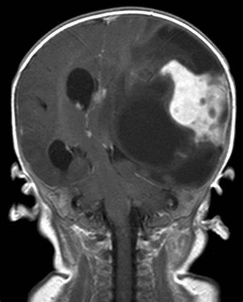 Case 1 Post Contrast T1 Weighted Coronal Image Showing A Predominantly