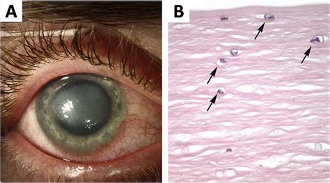 Ciliary Flush