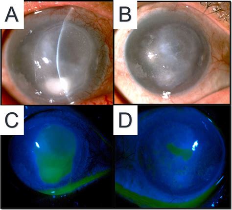 Neurotrophic Keratopathy General Features And New Therapies Survey Of Ophthalmology