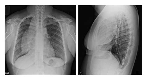 A Posteroanterior Chest X Ray Image Exhibiting Right Paramediastinal