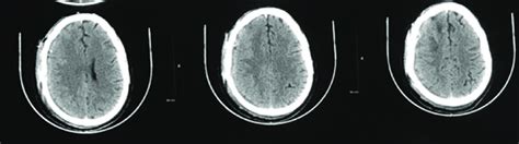 Postoperative Noncontrast Computed Tomography Head Axial Sections