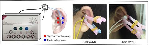 Transcutaneous Auricular Vagus Nerve Stimulation Tavns For Migraine