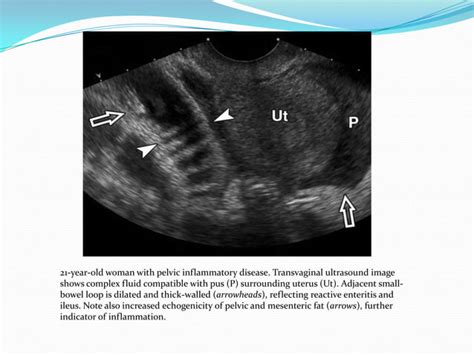 Ultrasound Imaging Of Bowel Pathology Ppt